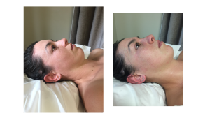 Facial Acupuncture